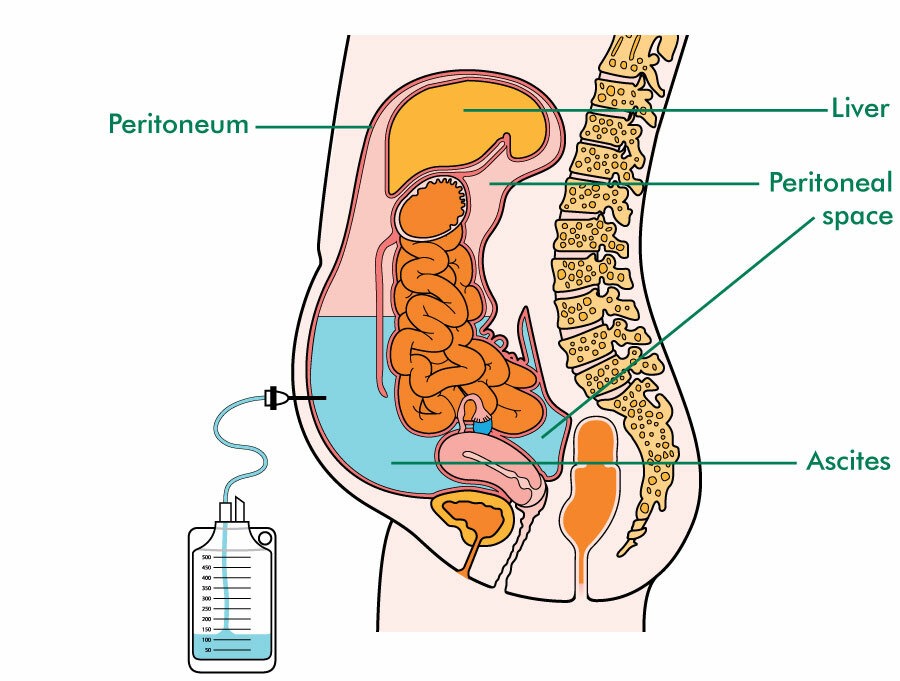 Ascites Macmillan Cancer Support