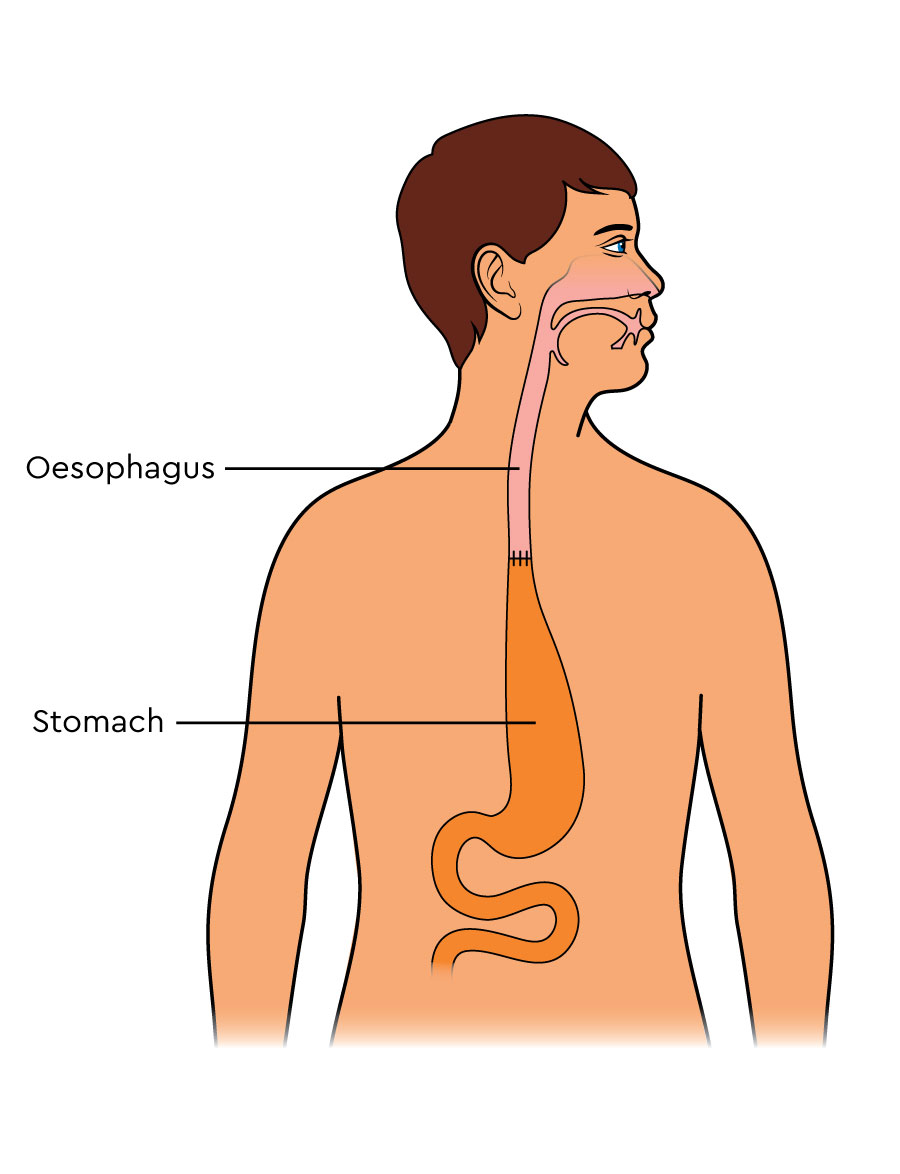 After the cancer is removed, the remaining part of the oesophagus is re-joined to the stomach, which has been pulled up to the middle part of the chest.