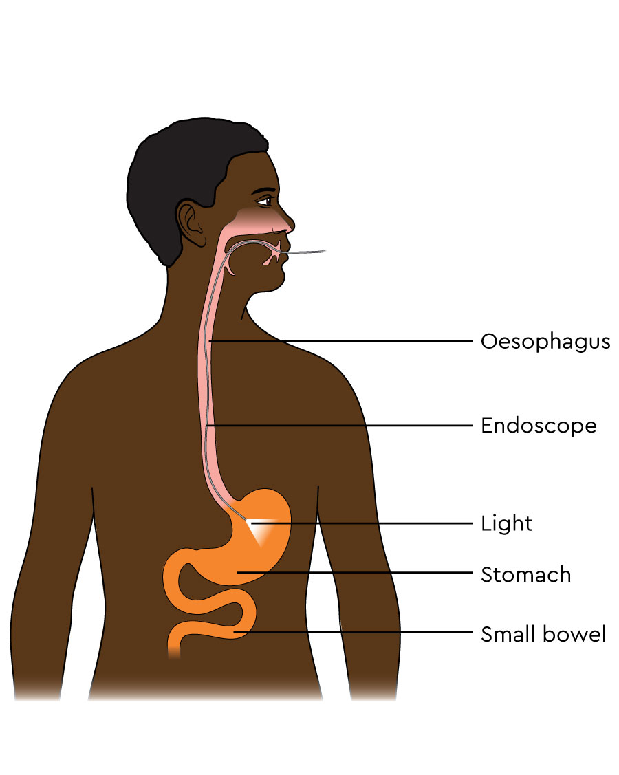 The illustration shows a long, thin tube (endoscope) going into the mouth and the oesophagus. The end of the endoscope is in the stomach.