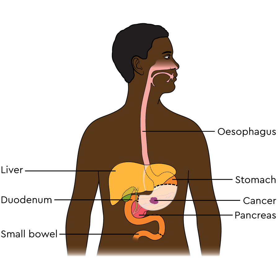A tumour is shown in the lower stomach. Dotted lines mark the section of stomach that is removed, and where a cut will be made in the small bowel.