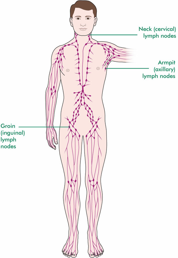 Secondary lymph node cancer - Macmillan Cancer Support