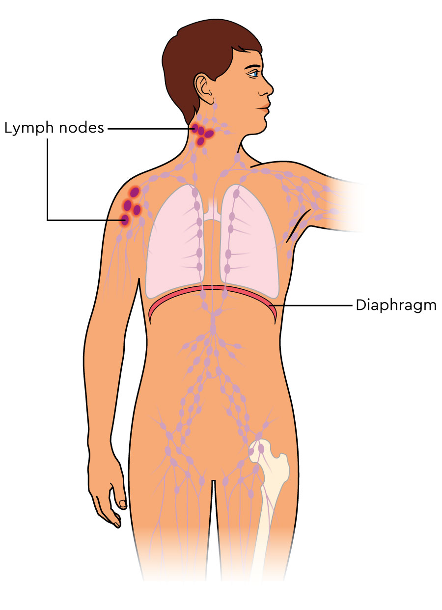 The body’s lymph nodes are shown. 4 nodes in the neck and 4 under the arm are highlighted to show there is lymphoma in these 2 areas.