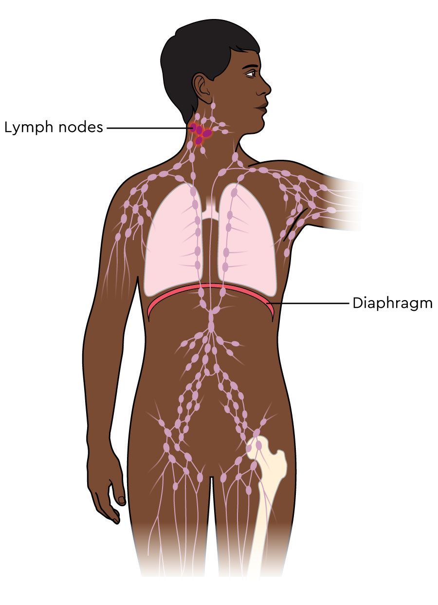 The body’s lymph nodes are shown. A group of 4 lymph nodes in the neck are highlighted to show there is lymphoma in this area only. 
