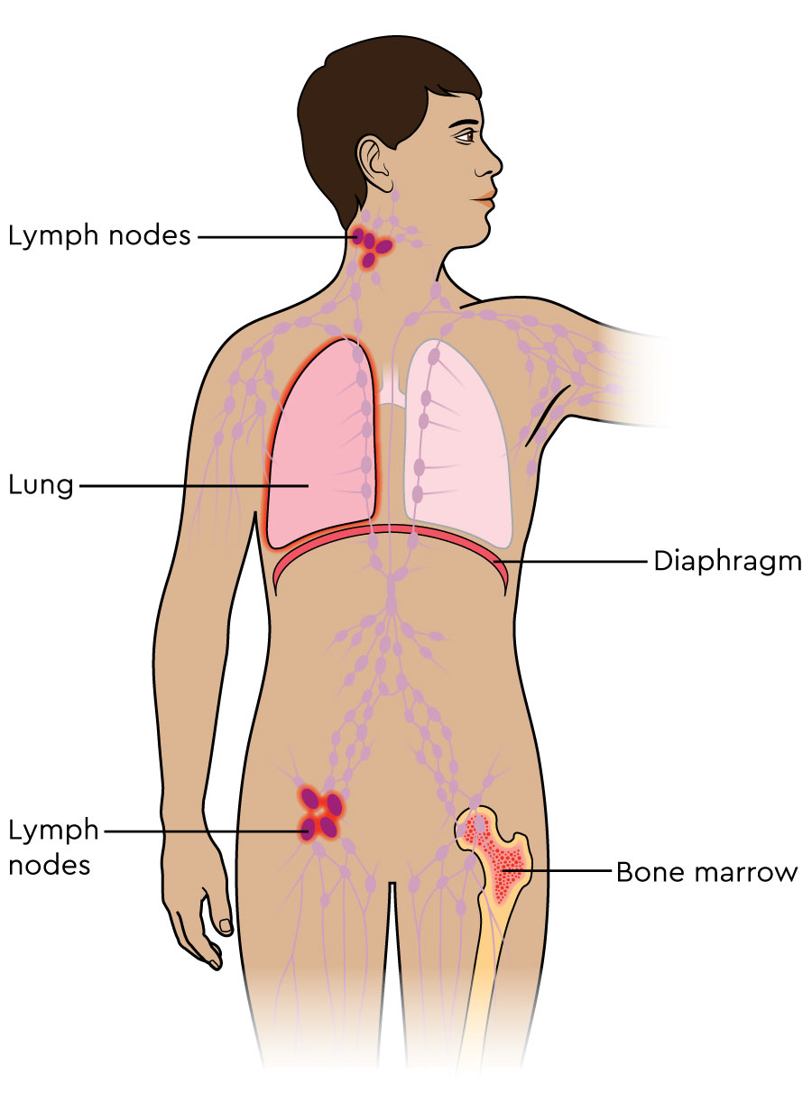 The body’s lymph nodes are shown. Lymphoma is shown in 4 nodes in the neck, 4 nodes in the groin, a lung and bone marrow in the hipbone.