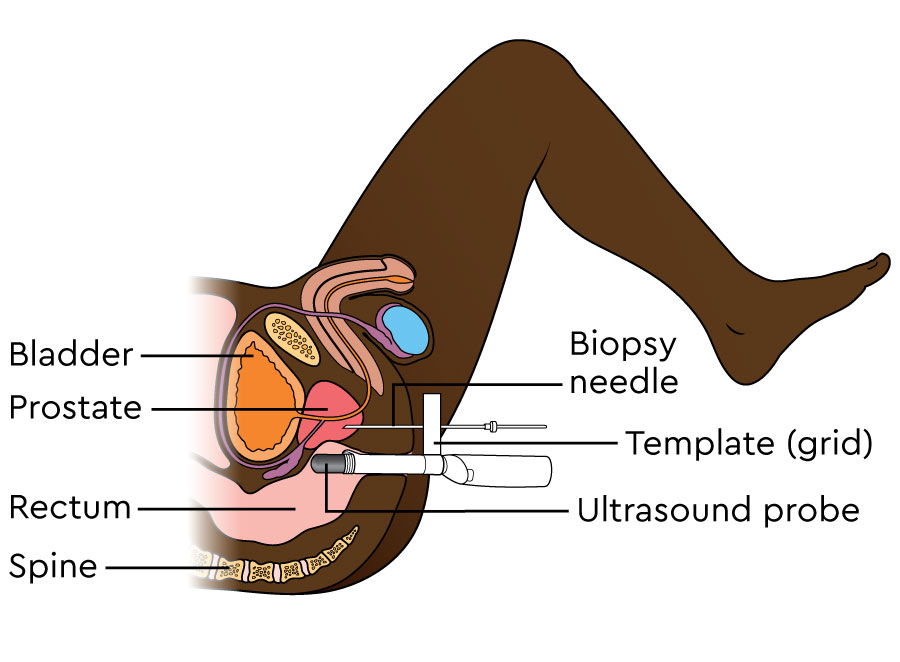 The illustration shows an ultrasound probe being passed into the rectum. Attached to the probe is a template. The probe is outside the body, positioned on the perineum. A needle passes through the template and into the prostate to take a sample of cells.