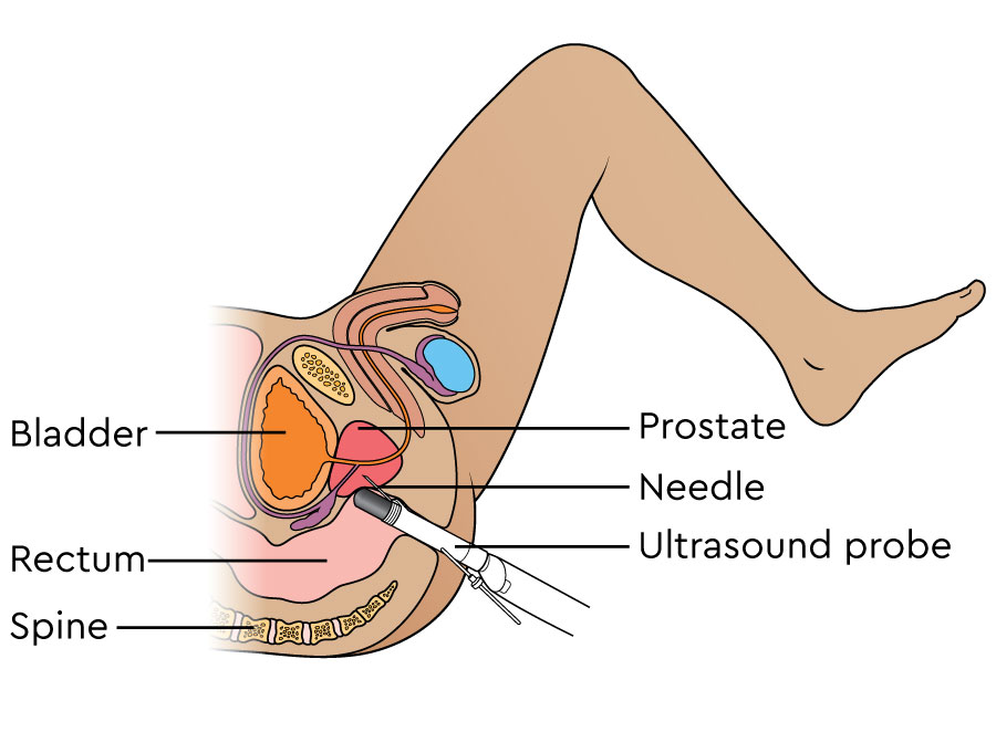 The illustration shows an ultrasound probe being passed into the rectum. A needle from the probe goes into the prostate to take a sample of cells.