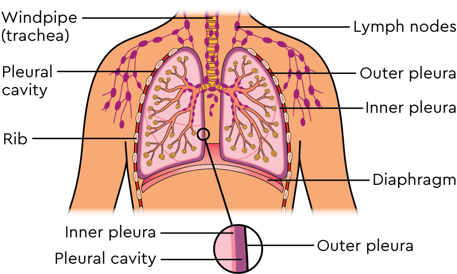 A diagram of the lungs and pleura, showing a close-up of the inner pleura, outer pleura and the pleural cavity.