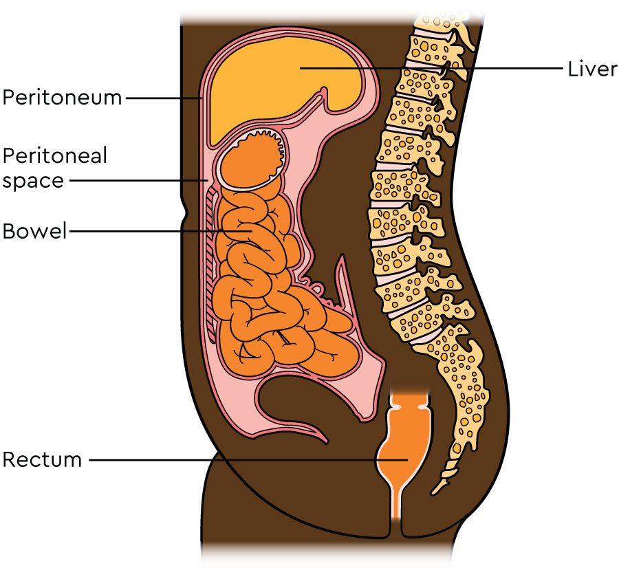 A diagram of the side view of the tummy, showing the internal organs including the liver, stomach and bowel. Also shown is the peritoneum, the inner and outer layers, and the space between them called the peritoneal cavity.