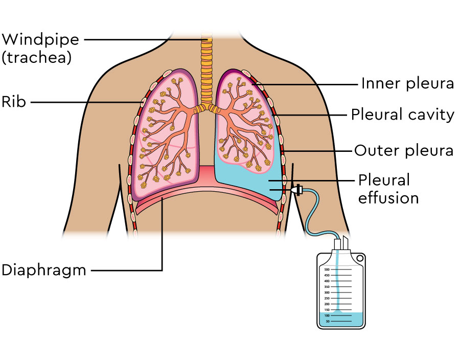 An illustration showing the lungs in the chest. The person’s left lung has fluid between the inner pleura and the outer pleura. This is called a pleural effusion. A small bag is attached to the lung by a thin tube. The fluid is draining into the bag.