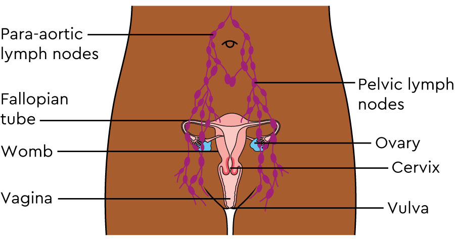 The diagram shows the female abdomen and pelvis from the front. It shows a network of fine tubes and small oval shapes. These are the pelvic lymph nodes.