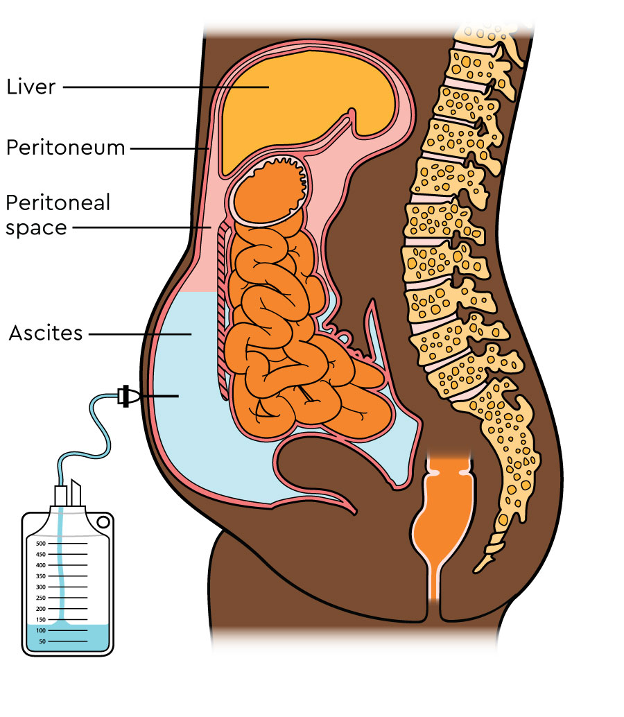 Diagram showing a side view of the body, including the peritoneum, peritoneal space, and the liver. There is fluid inside the peritoneum (ascites) stretching the tummy. There is a drainage bag collecting fluid from the peritoneum.