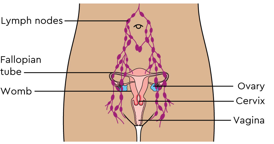 The diagram shows the female abdomen and pelvis from the front. It shows a network of fine tubes and small oval shapes. These are the pelvic lymph nodes.