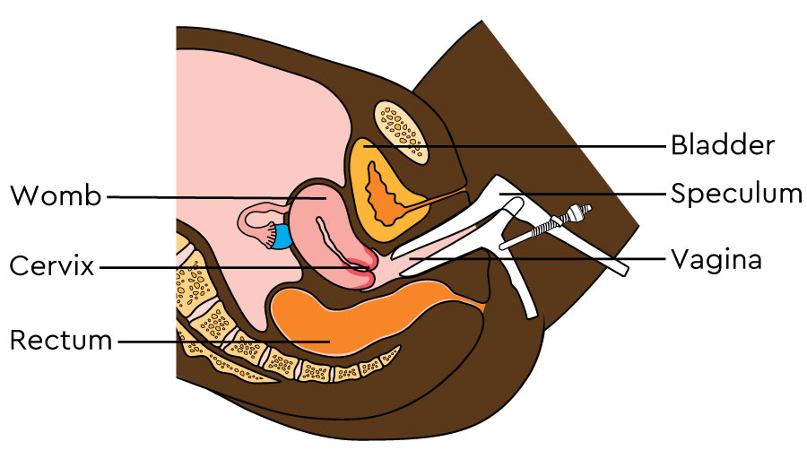 An image of a female’s lower abdomen, pelvis and upper thigh from the side. It shows the bladder, womb, back passage (rectum), vagina, cervix and the womb. An instrument called a speculum is shown sitting in the vagina