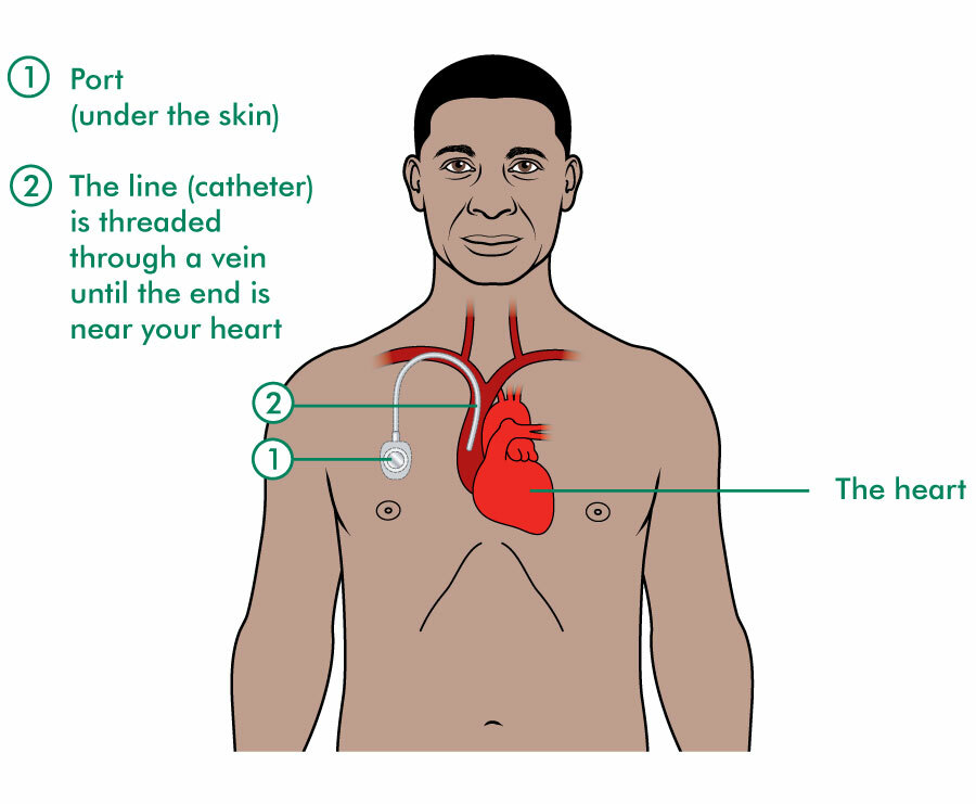 chemotherapy port