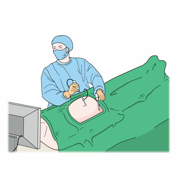 Laparoscopy