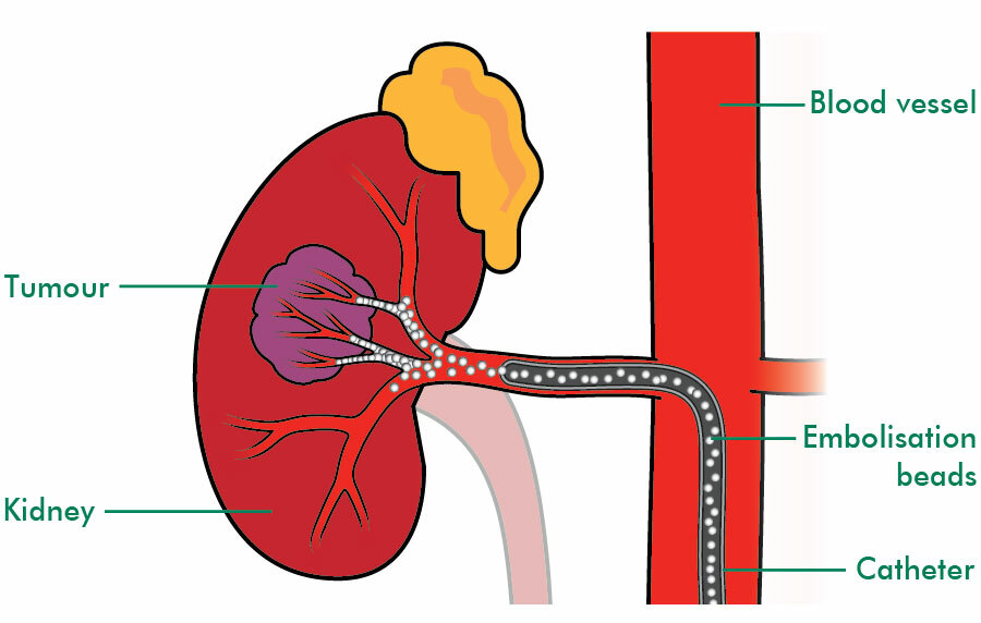 Arterial embolisation for kidney cancer Macmillan Cancer Support
