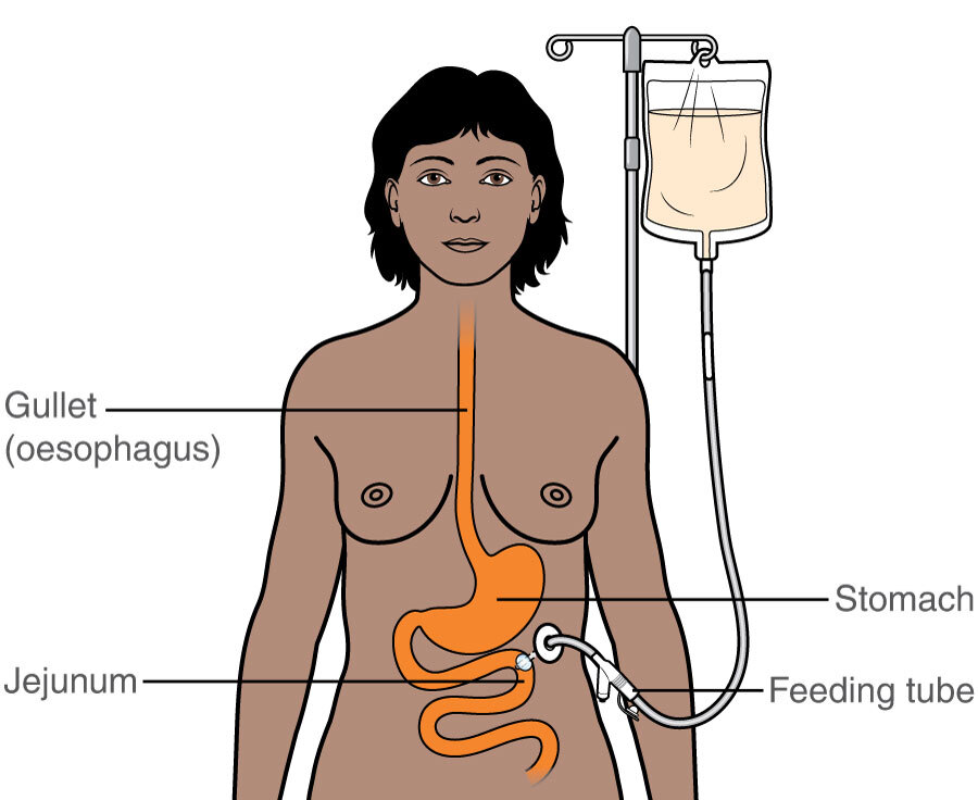 Tube feeding into the gut (enteral nutrition) | Macmillan Cancer Support