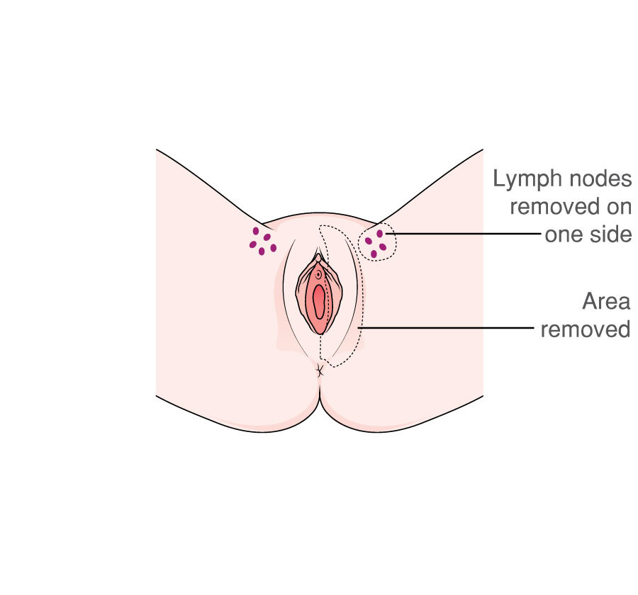 MACD104 Vulva radical partial vulvectomy side 