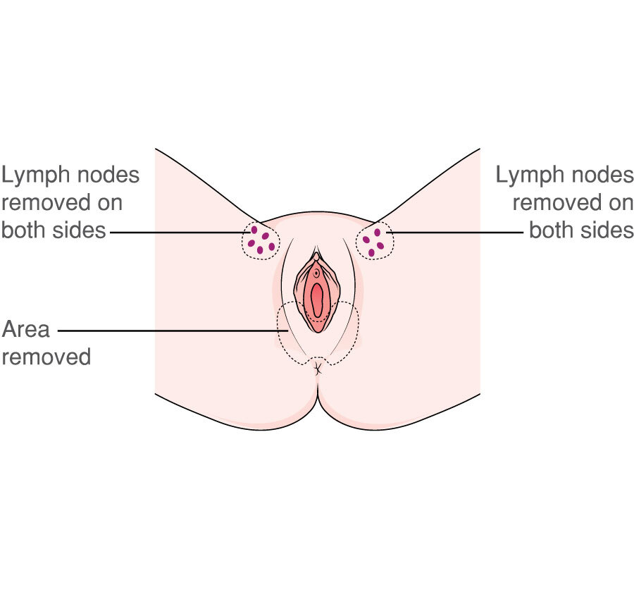 MACD103 Vulva radical partial vulvectomy lower 