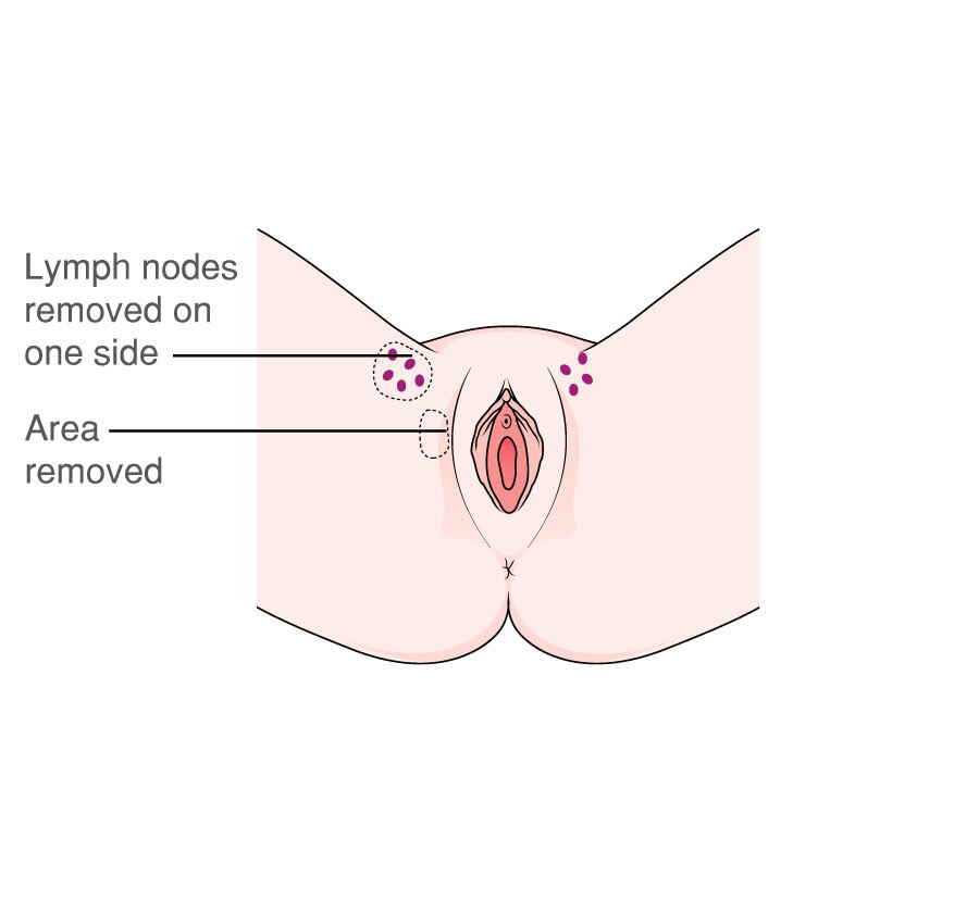 MACD101 Vulva radical wide local excision 