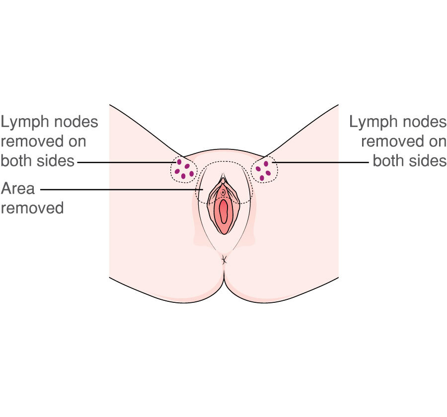 MACD102 Vulva radical partial vulvectomy upper