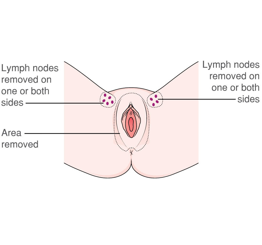MACD105 Vulva radical vulvectomy