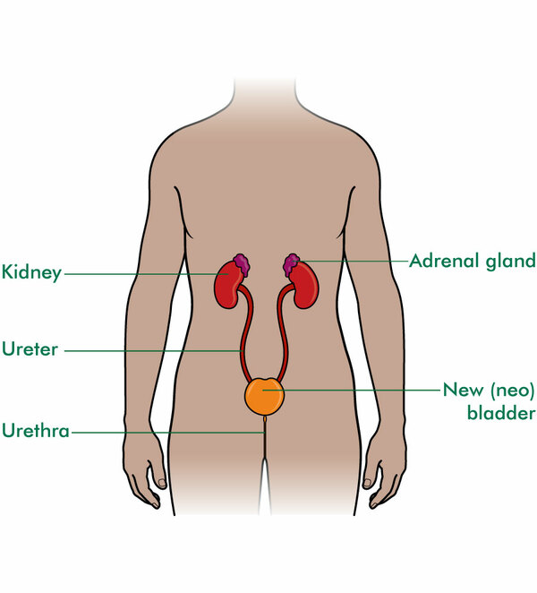Bladder reconstruction Macmillan Cancer Support
