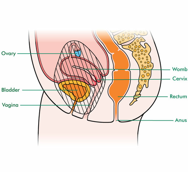 types of pelvic exenteration for women macmillan cancer support