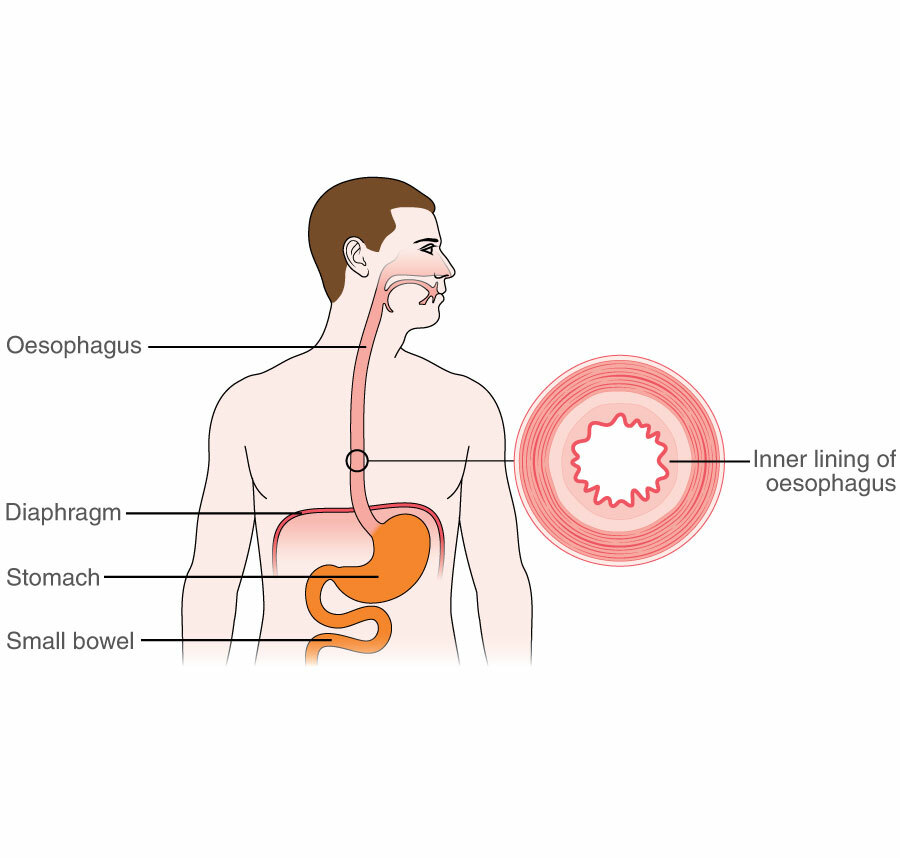 Acid reflux golf ball in throat