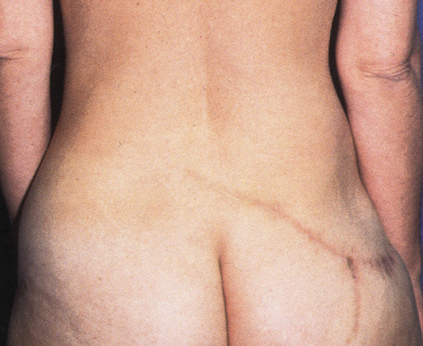 SGAP flap reconstruction (back)