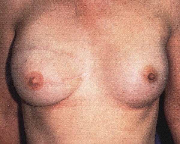 SGAP flap reconstructions (front)