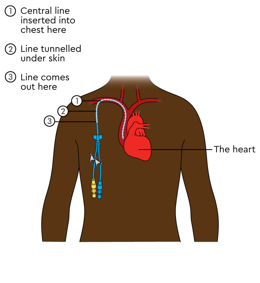 Your Hickman line