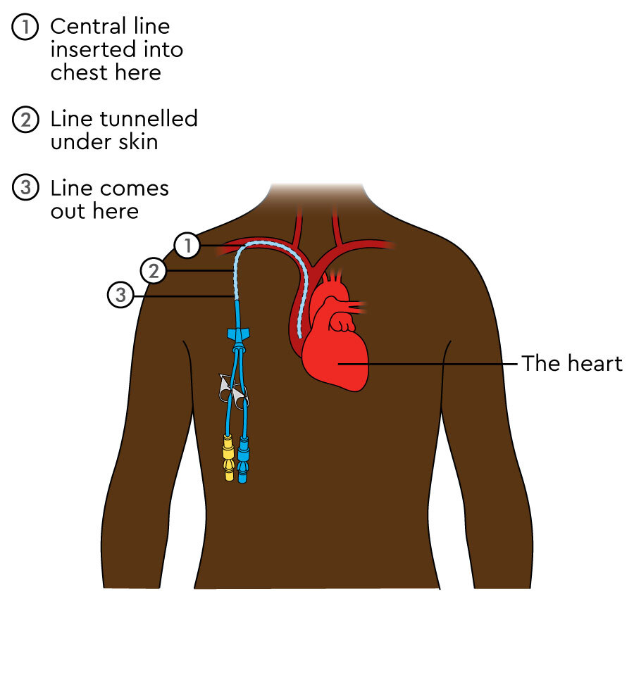 Tunneled Central Venous Catheter